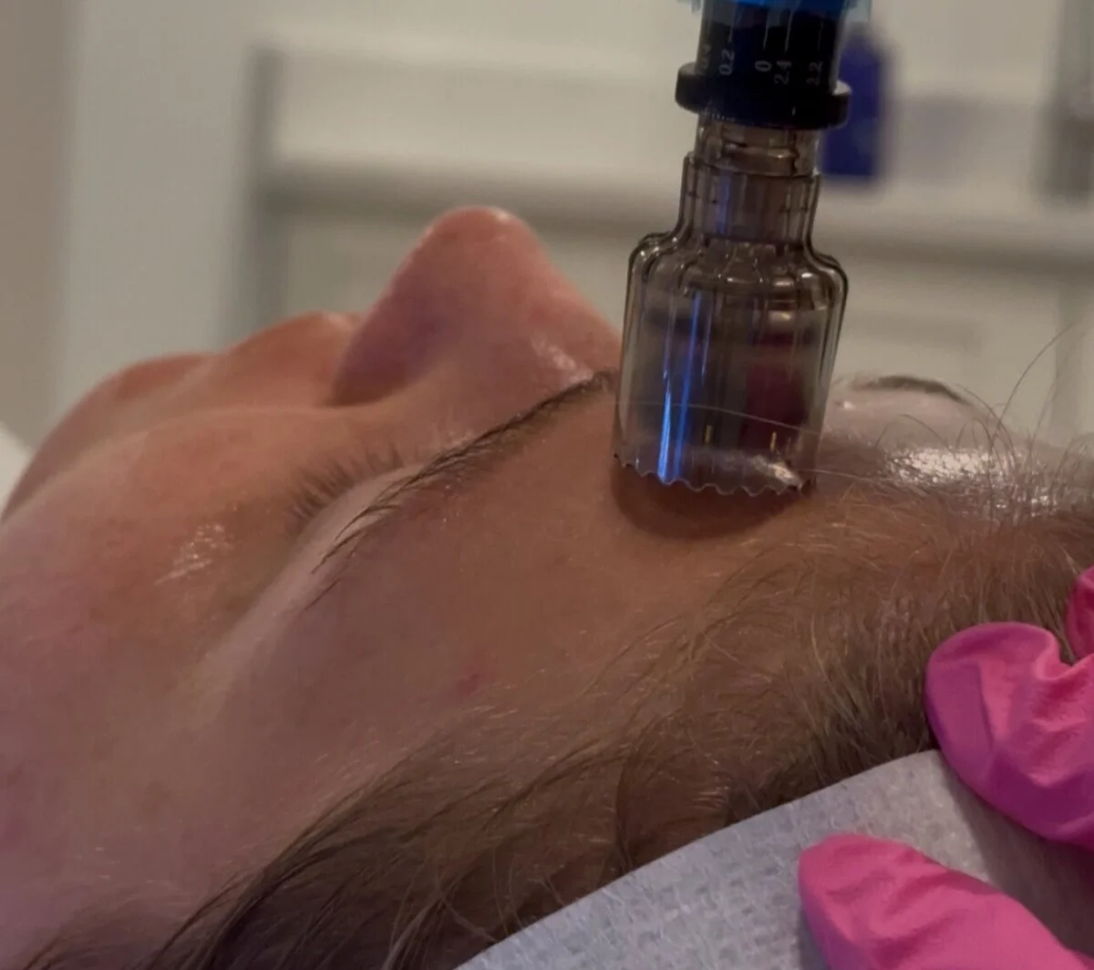 best microneedling services in panama city fl