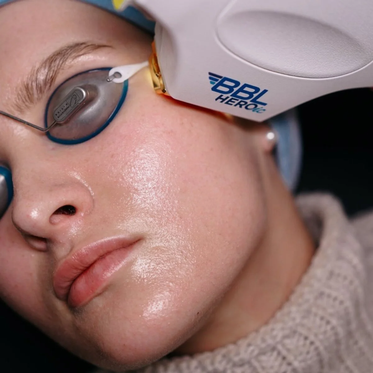 sun damage laser treatment in panama city fl