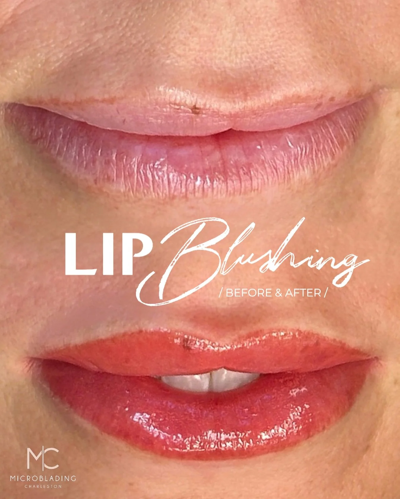 Lip gloss? Overrated. ๐
When your lips already have that perfect tint 24/7 — no smudging, no reapplying, just wake up and go ๐
That’s the power of Lip Blushing — soft, natural color that makes your lips look fresh and kiss-ready e