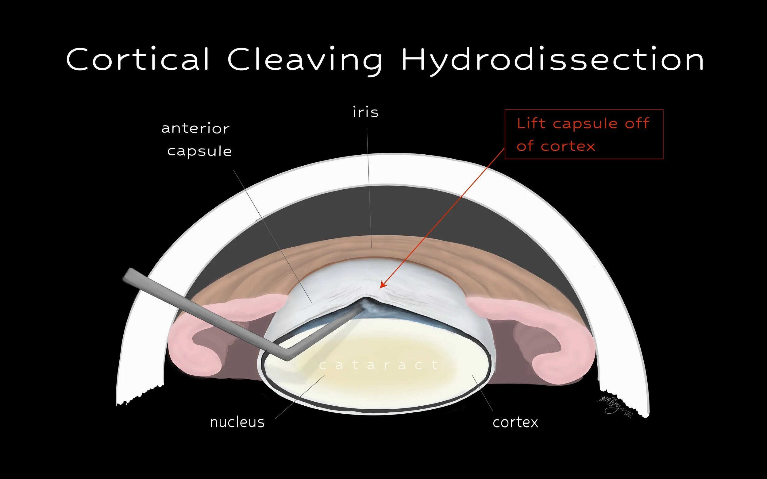 Cortical cleaving hydrodissection in cataract surgery (digital)