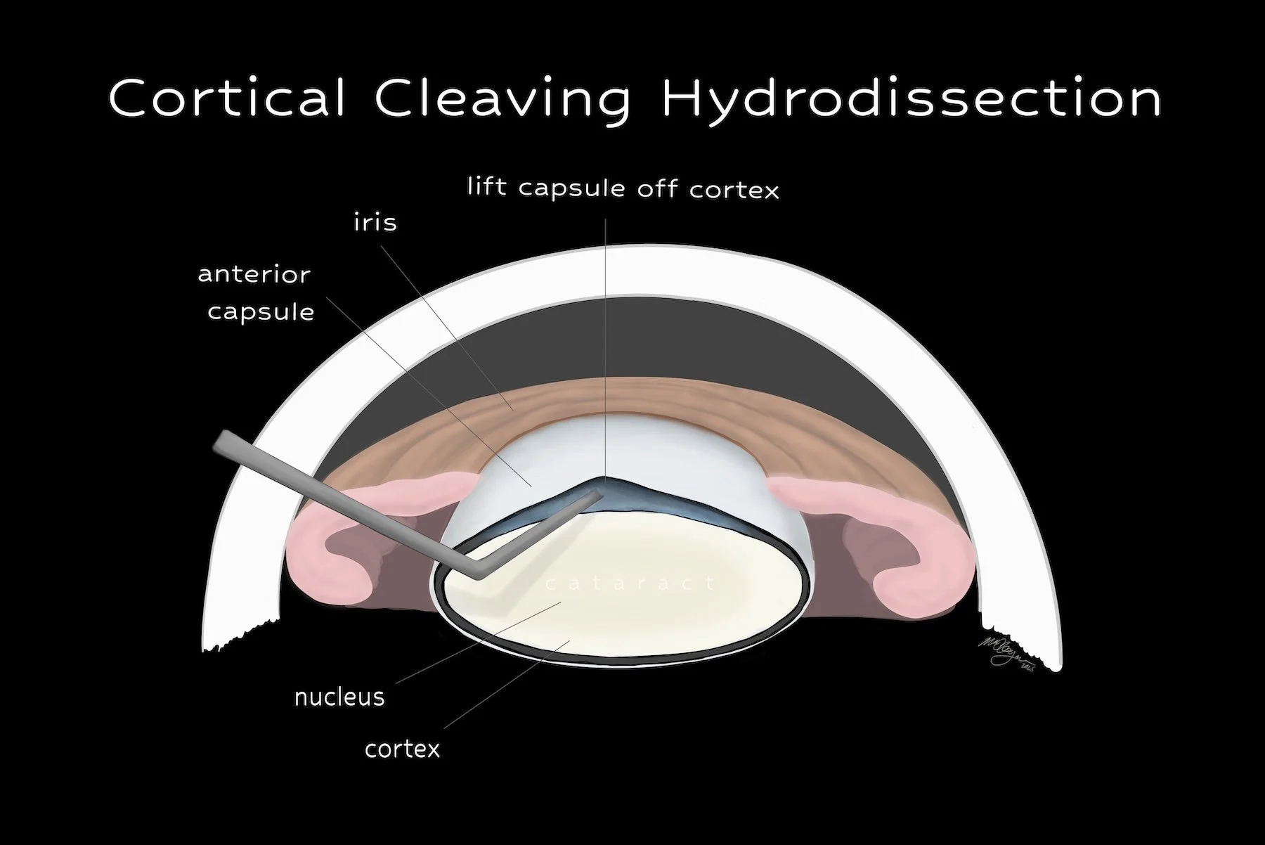 Cortical cleaving hydrodissection in cataract surgery (digital)