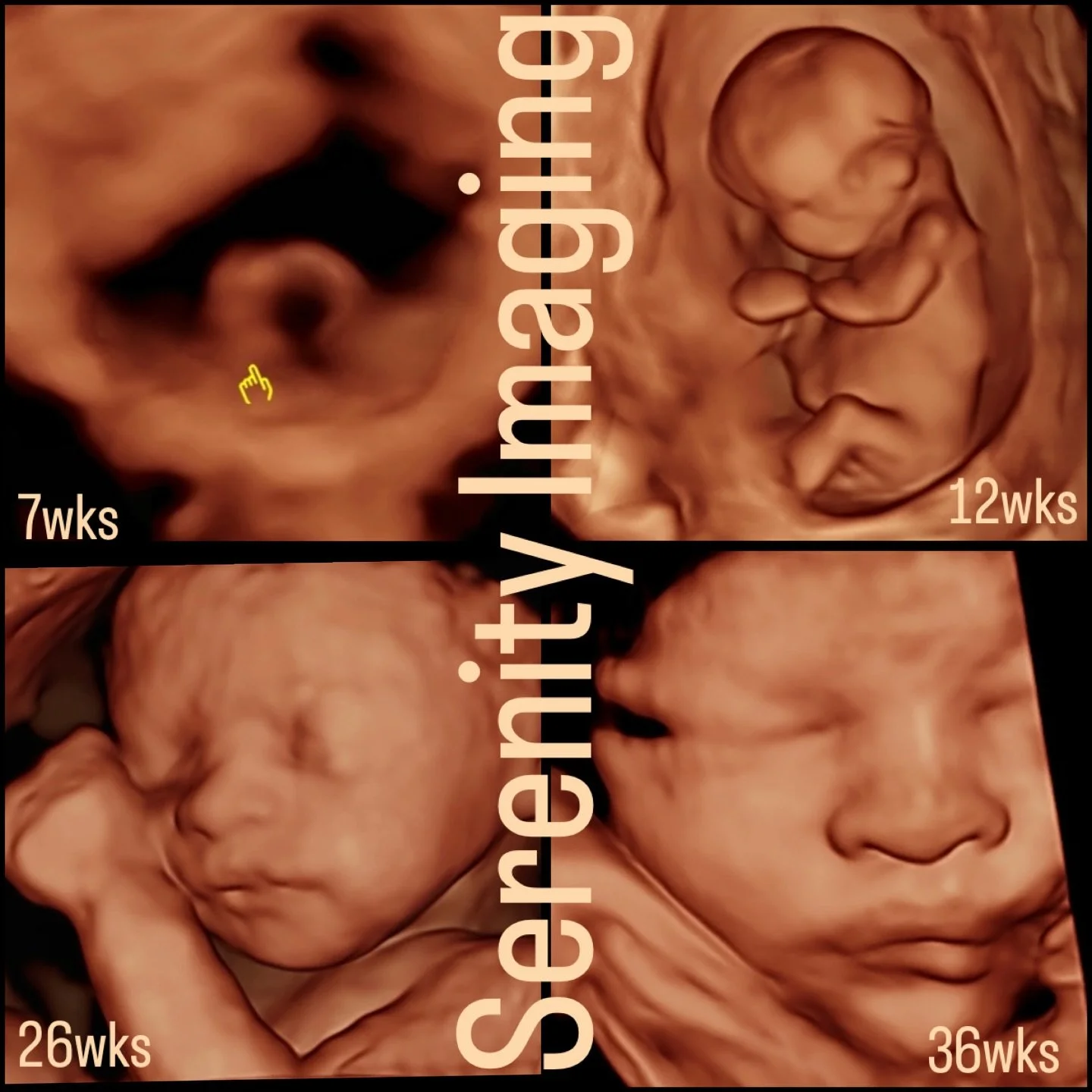 Watch your baby grow 😍 from the very beginning. 💕
Every step of your pregnancy is a moment to cherish, and at Serenity Imaging, we&rsquo;re here to help you capture those unforgettable memories.
✨ From tiny heartbeats to sweet baby faces, let us do