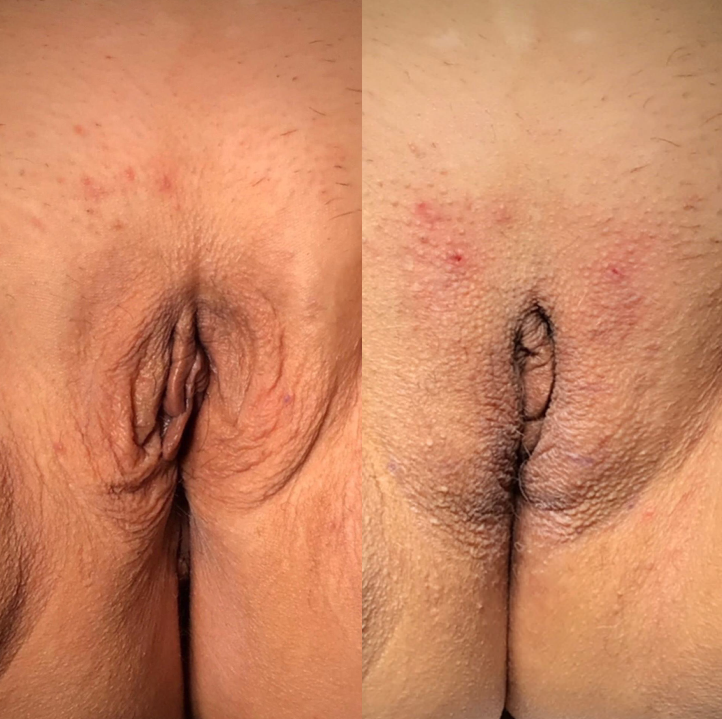 Relleno labios íntimos | Viñals & Polo