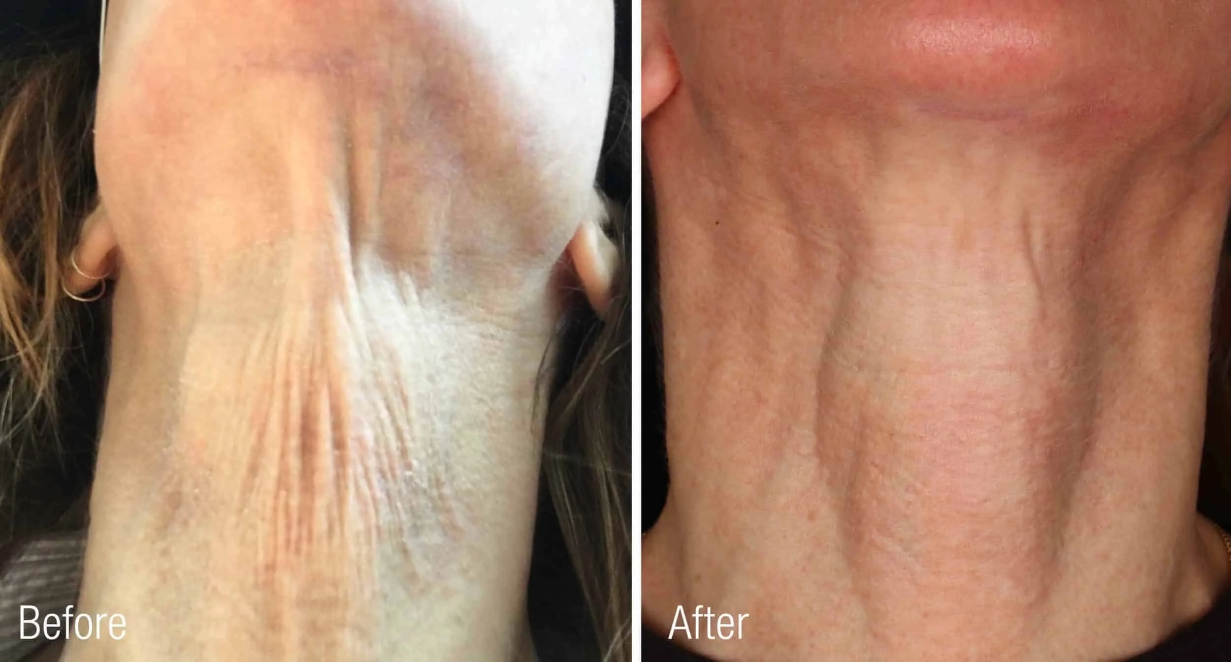Neck-Before-After-Renuva-scaled-1.jpeg