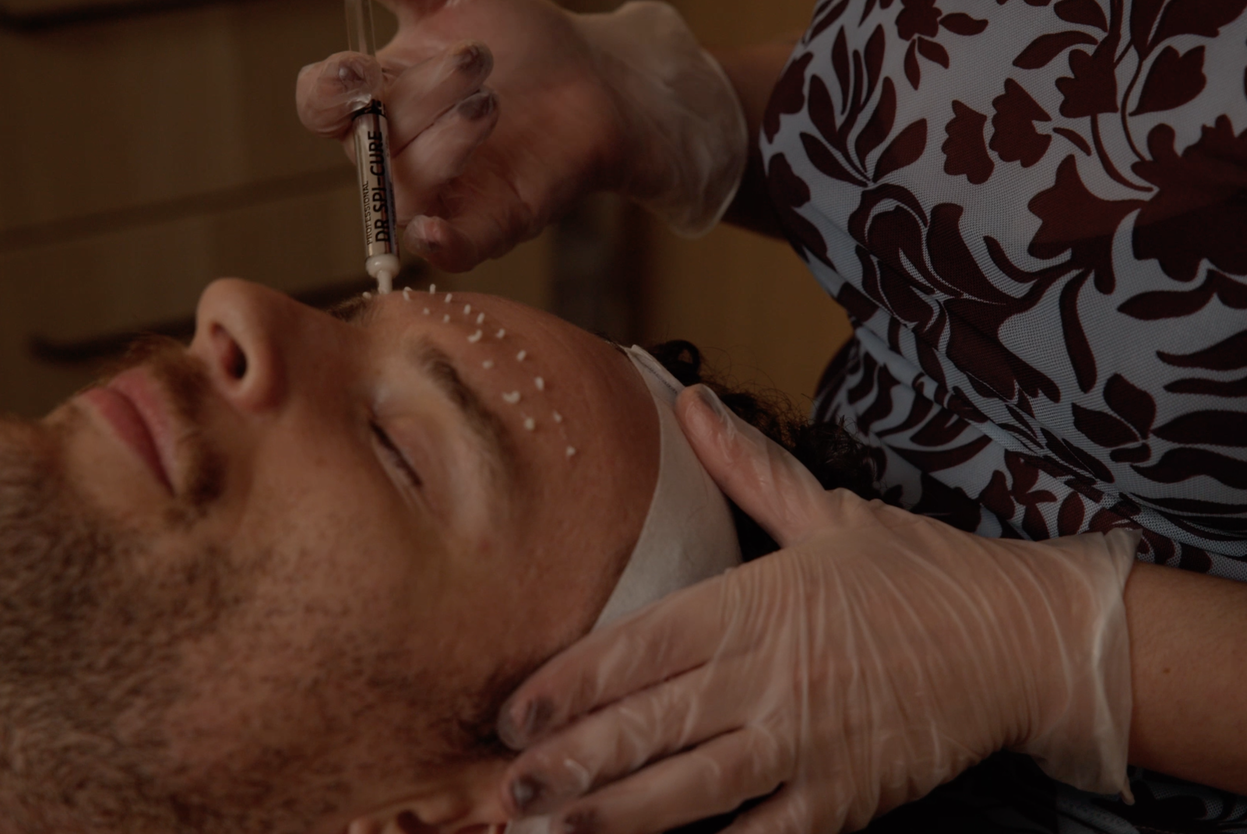 A person receiving a cosmetic injection in the forehead while lying down, with multiple small white markings on their face for guidance.