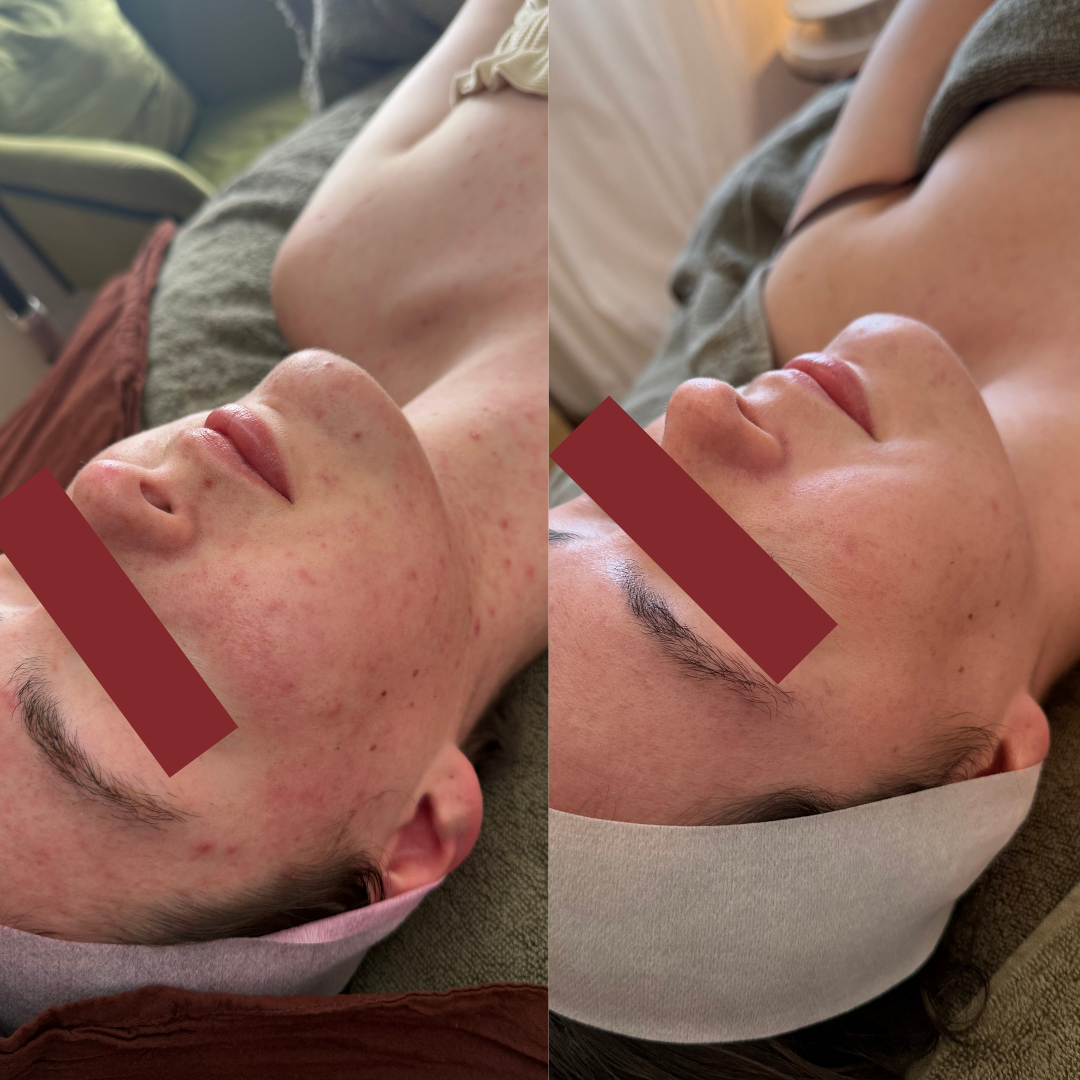 LED, enzyme peels, extraction