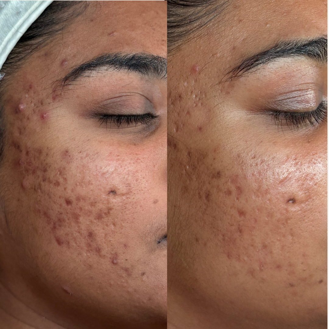 combo customised facials and skin needling