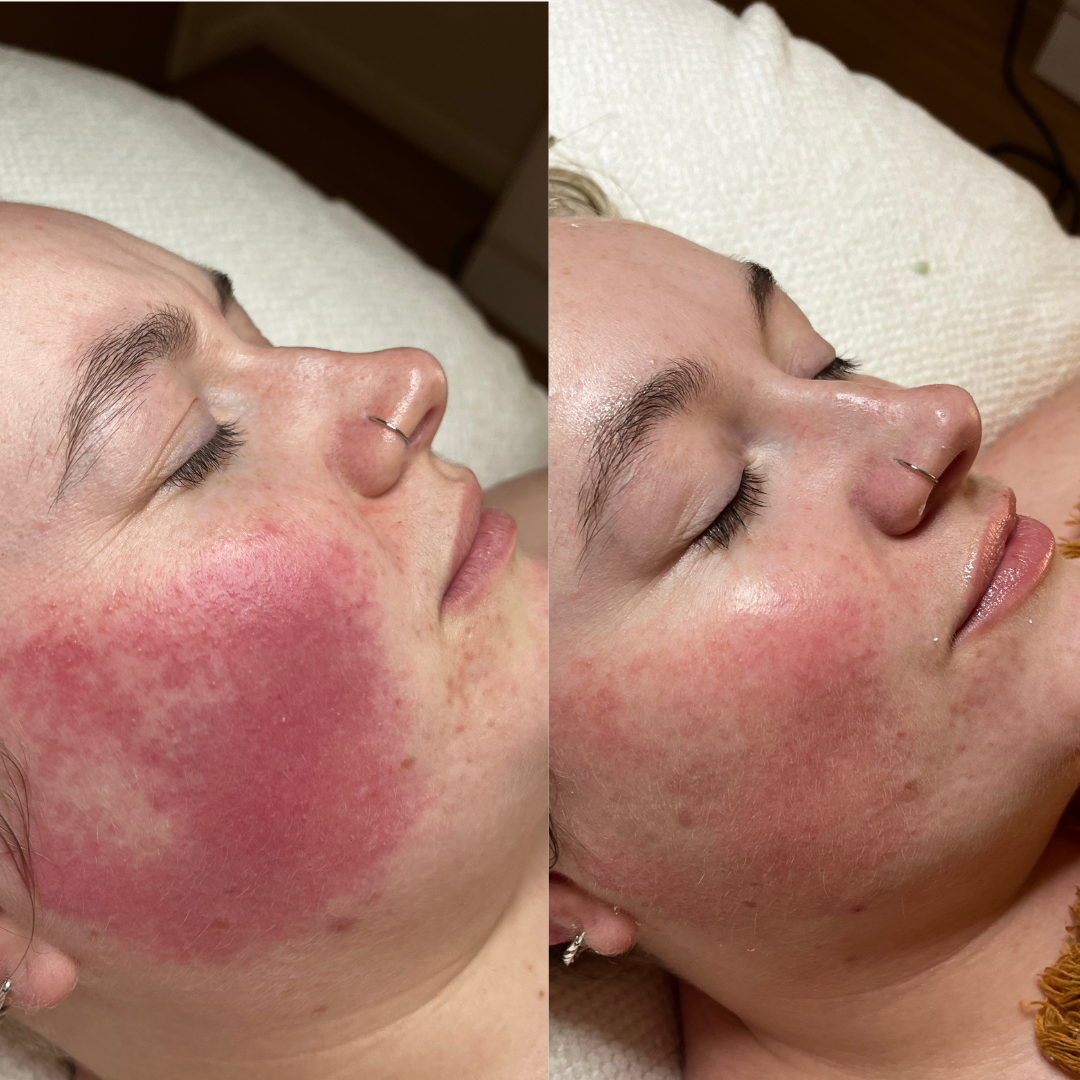 Immediately pre and post customised facial 