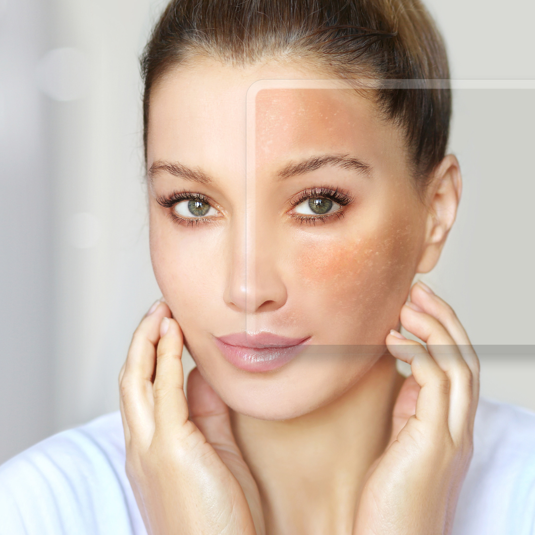 Why Long Islanders Are Choosing MOXI Laser for Radiant Skin
