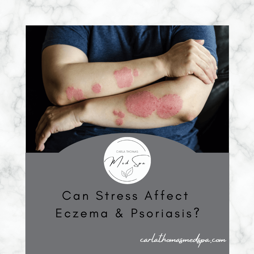 Can Stress Affect Eczema &amp; Psoriasis?