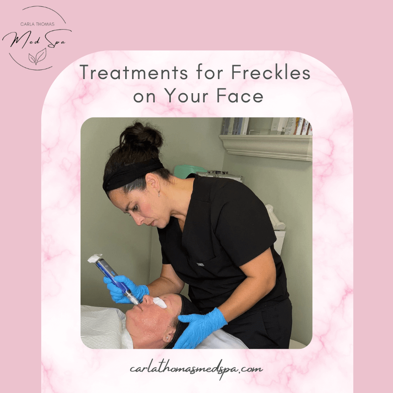 Treatments for Freckles on Your Face