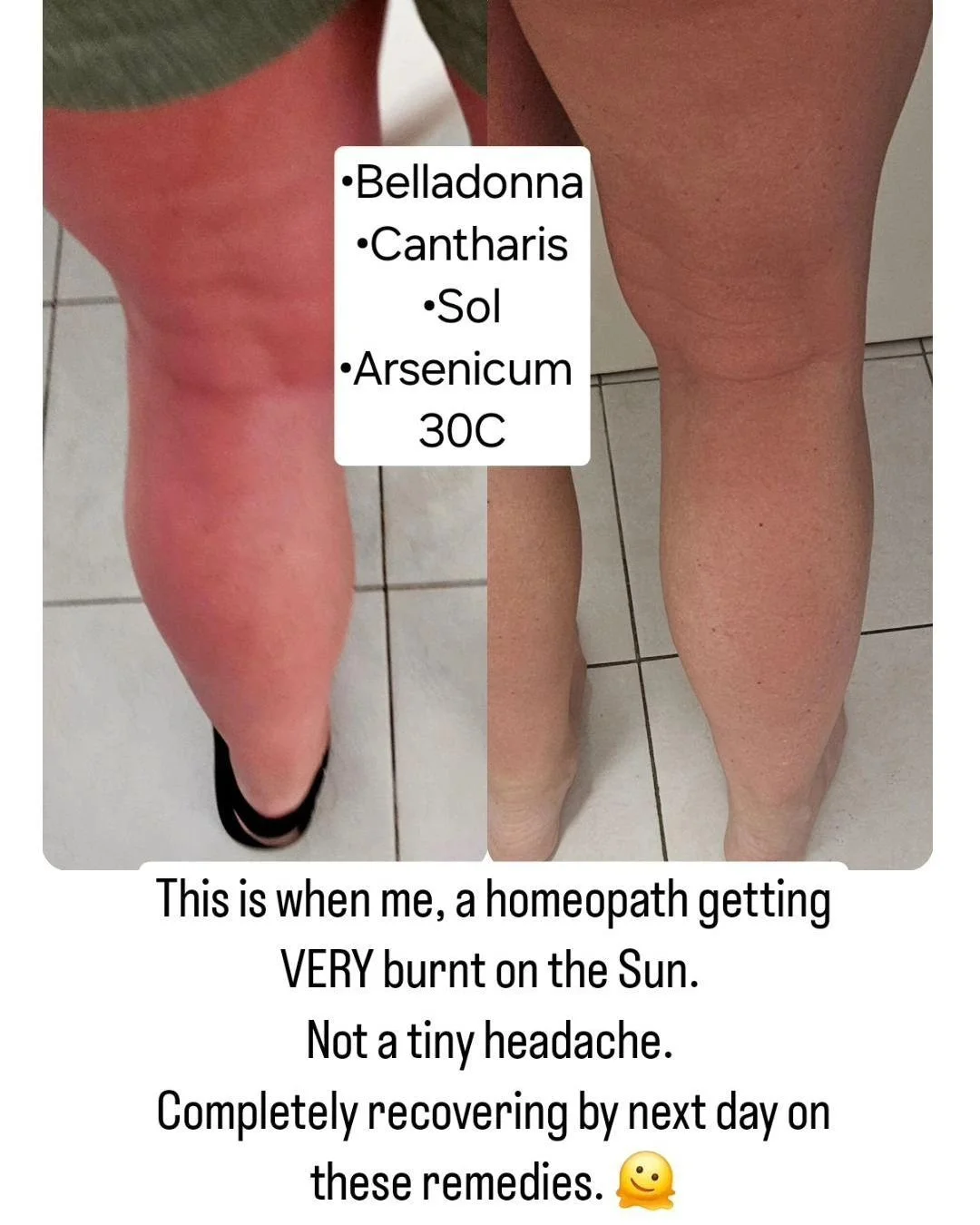 #sunburn #sunbathing #homeopathy #homeopath #naturalremedies #naturalmedicine #acutecare #emergencymedicine #emergency #burn #suntan #skinburns #firstaid #firstaidkit #holistic #healthcoaching #holistichealth #wellbeing #selflove