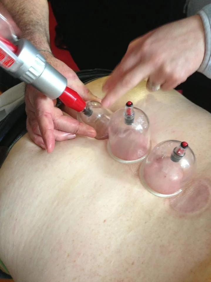 Cupping for pain and Stagnation!