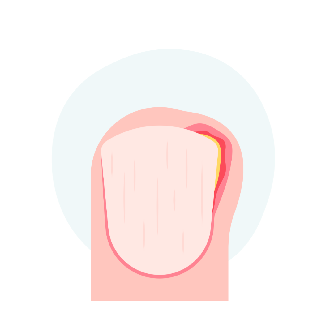 Ingrown Toenail — Tea Nguyen, DPM