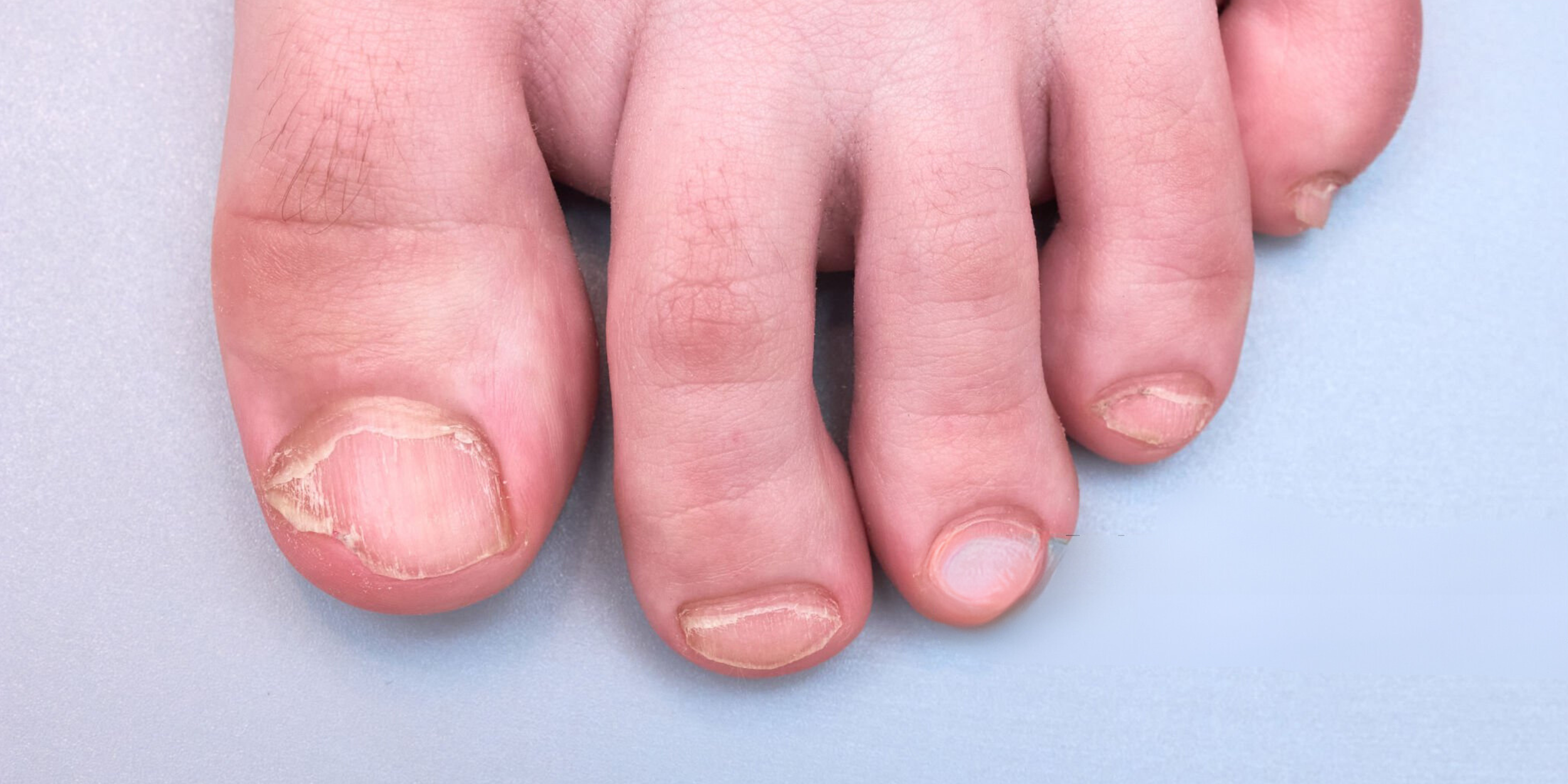 From Split to Brittle: Effective Solutions for Treating Toenail ...