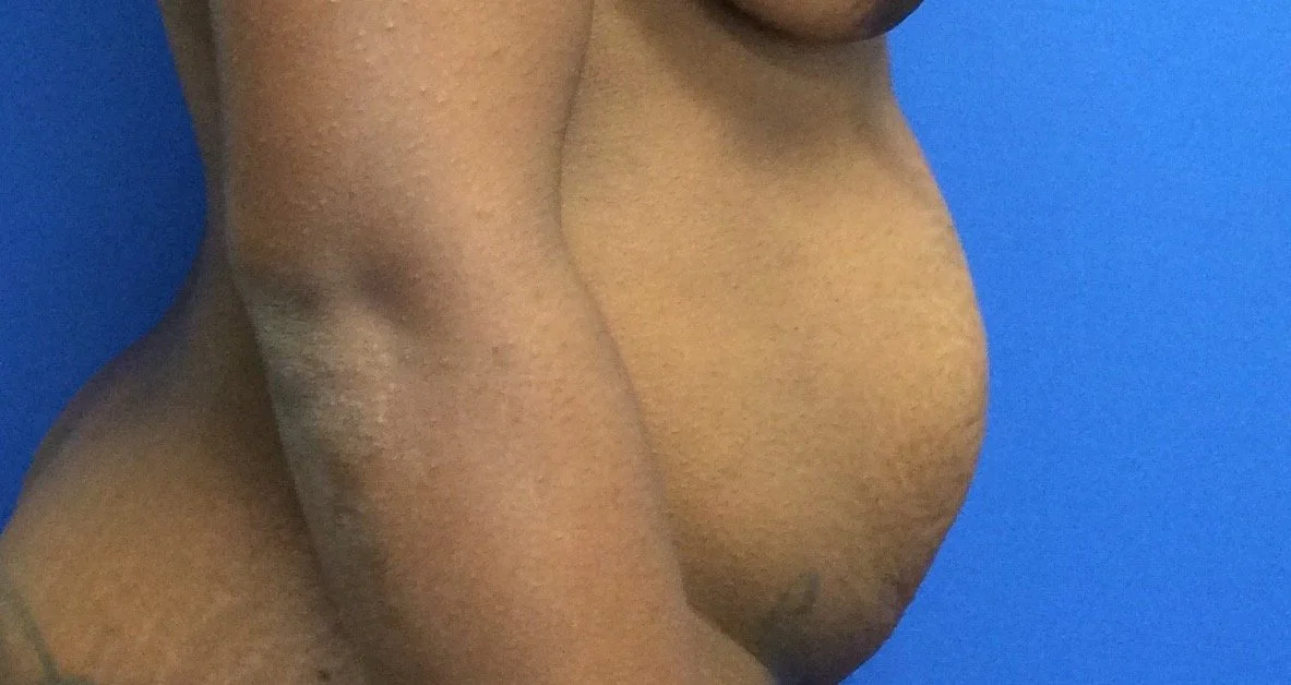 Abdominoplasty Tummy Tuck