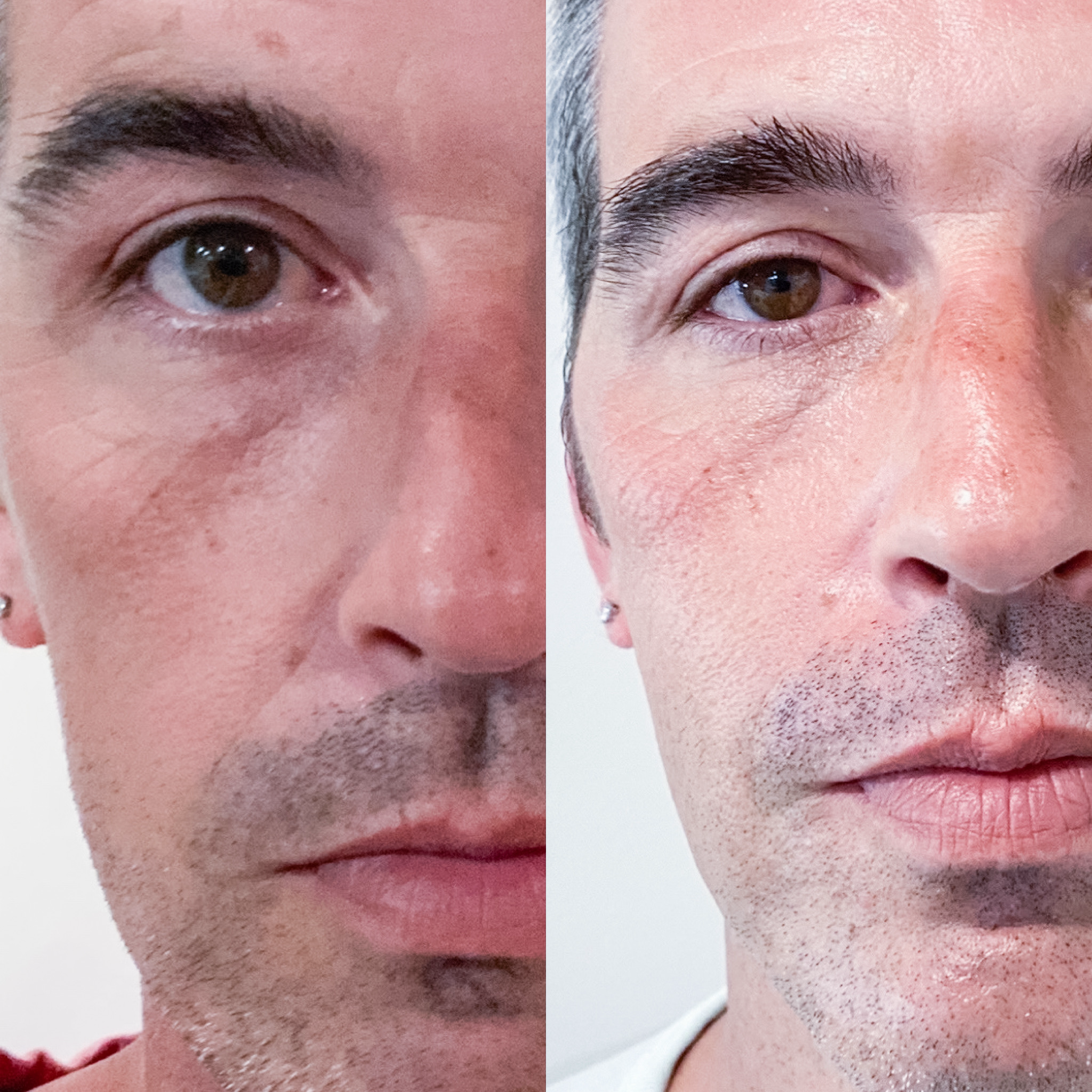 This client received "Glowtox"; botox &amp; the "No-Peel" Glow Peel! Results over 2-weeks.