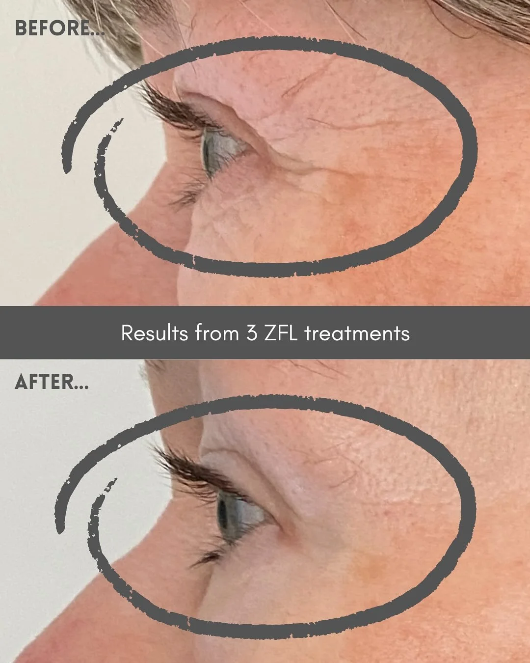 Spot the difference&hellip; 😉

So I was thinking of putting these before and after images into a reel, but then I remembered just how much we all love to zoooooooom in 🔍 😂

Welcome to the incredible 🌟Zone Face Lift🌟

This reflexology based holis