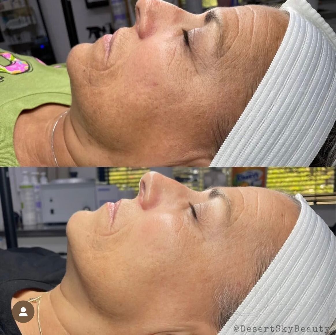 No filter! Procell Microchanneling is THAT service. It&rsquo;s amazing for scarring, hyperpigmentation, skin tightening, anti-aging. This is THAT service!

#rockhill #rockhillsc #rockhillsouthcarolina
#rockhillsc #smallbusinessbigdreams#fortmill #for