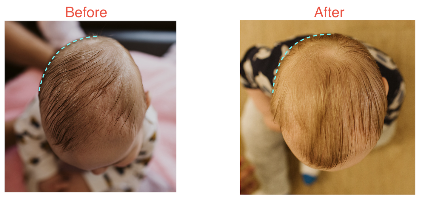 4 Ways to Check If Your Baby's Flat Head is a Problem