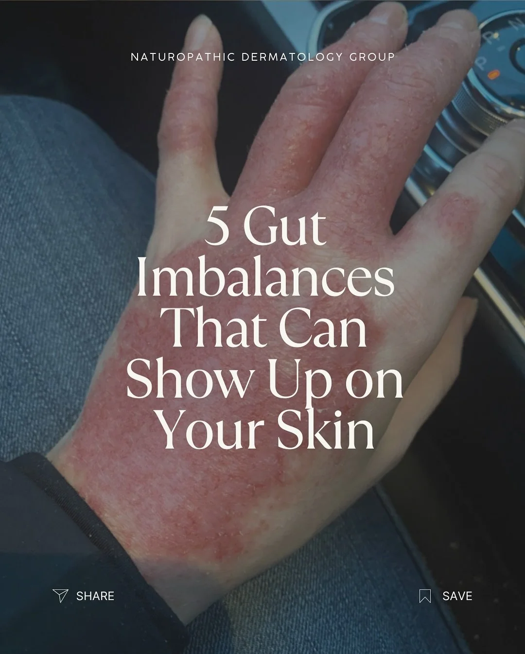 Your skin is often a reflection of what&rsquo;s happening in your gut. Here are 5 gut imbalances that can drive chronic skin conditions.

Schedule a FREE phone consultation to talk to Dr. Miller about your individual case. Link in bio.

#naturopathic