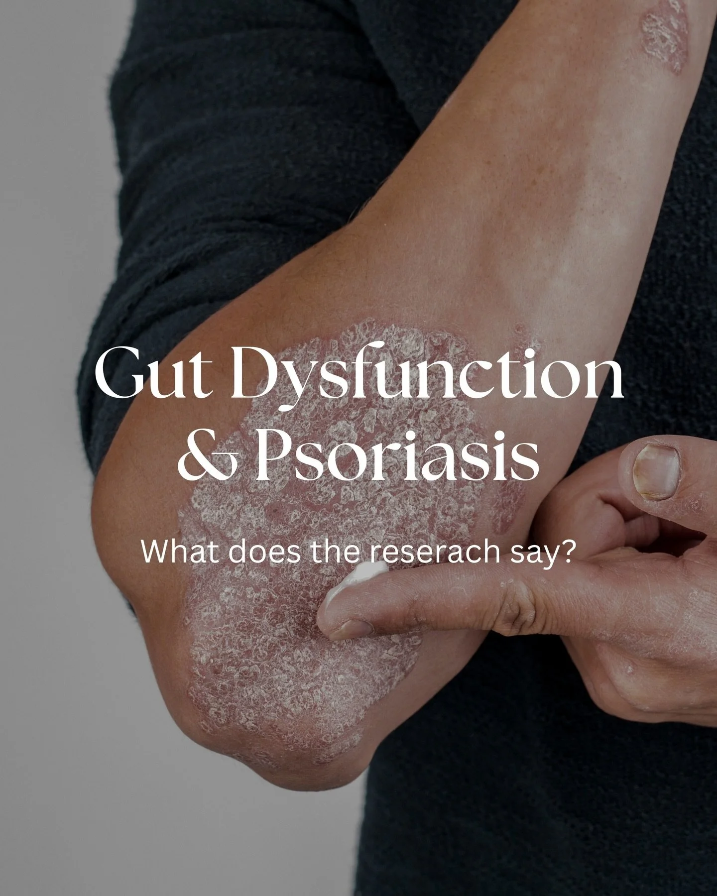 The gut skin connection in psoriasis is heavily supported by data in 2026. Here is what the research says about which types of gut dysfunction are associated with psoriasis.

#psoriasis #gutskinconnection #sibo #hpylori #naturopathicmedicine