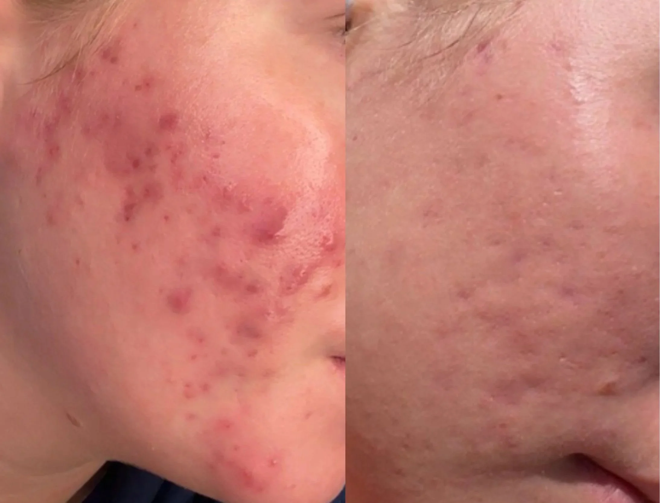 4 months, treatment ongoing