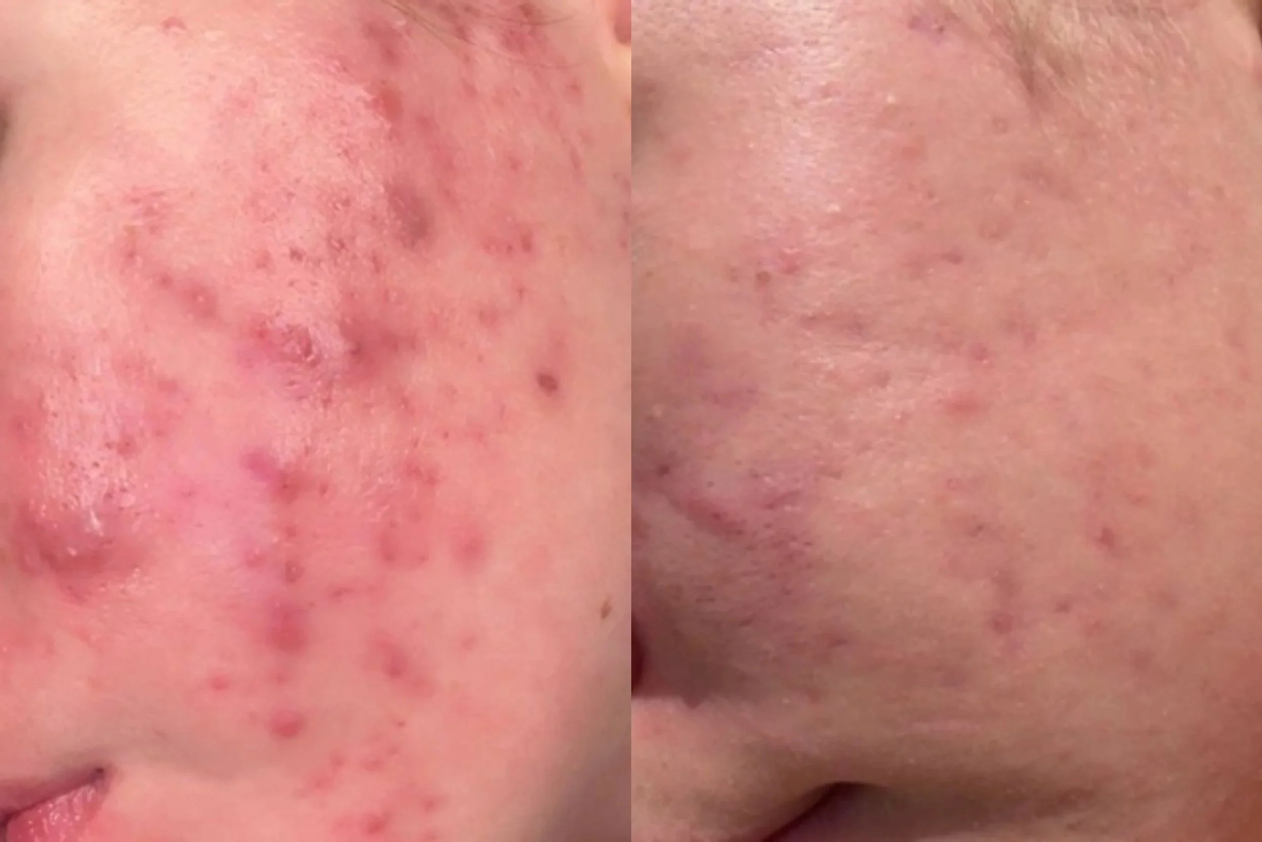 4 months, treatment ongoing