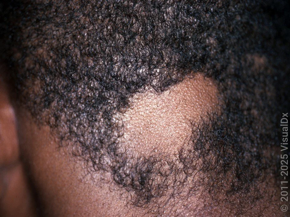 Alopecia Areata