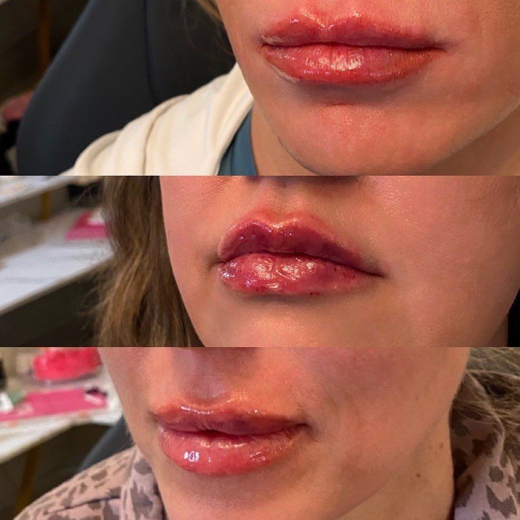 💋 Lip Goals? Let&rsquo;s Talk Strategy! 💉✨

Before we even think about a syringe, it&rsquo;s all about assessment &mdash; the behind-the-scenes magic that turns lip filler into an art form. 🎨💕

Every pout is different, and we love that. Your natu