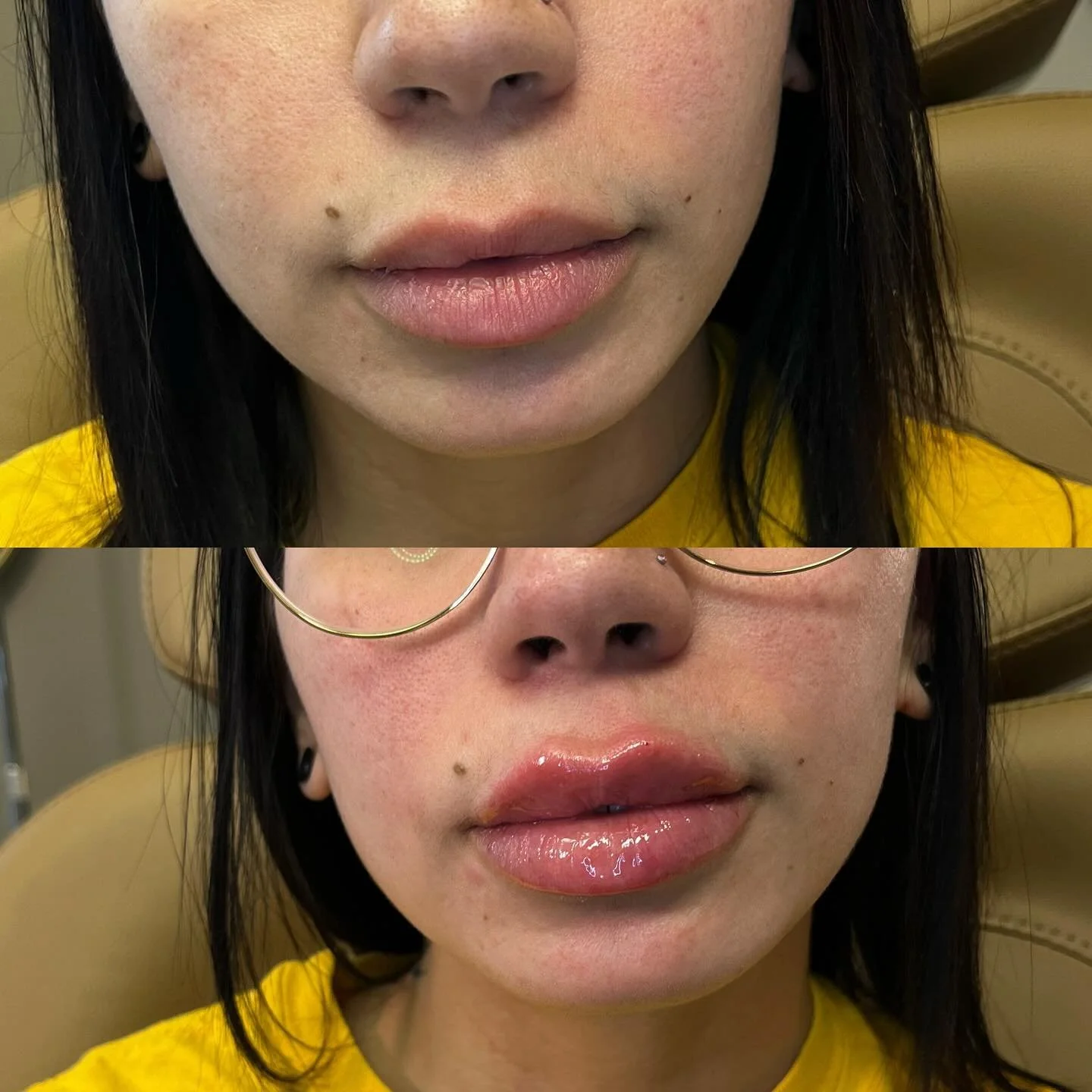 ✨ I&rsquo;ve been performing a large number of lip filler treatments recently, and I love seeing the confidence it brings my clients. Lip filler can restore hydration, enhance symmetry, and create a natural, refined pout tailored to your features.

?
