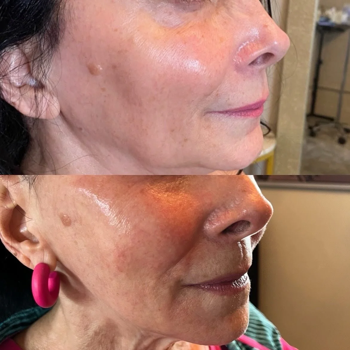 ✨ Consistency is everything when it comes to a facial game plan ✨

I&rsquo;ve been treating this beauty for 5 years, and the key to her results has been staying consistent. Together we&rsquo;ve built a plan that keeps her looking refreshed, balanced,
