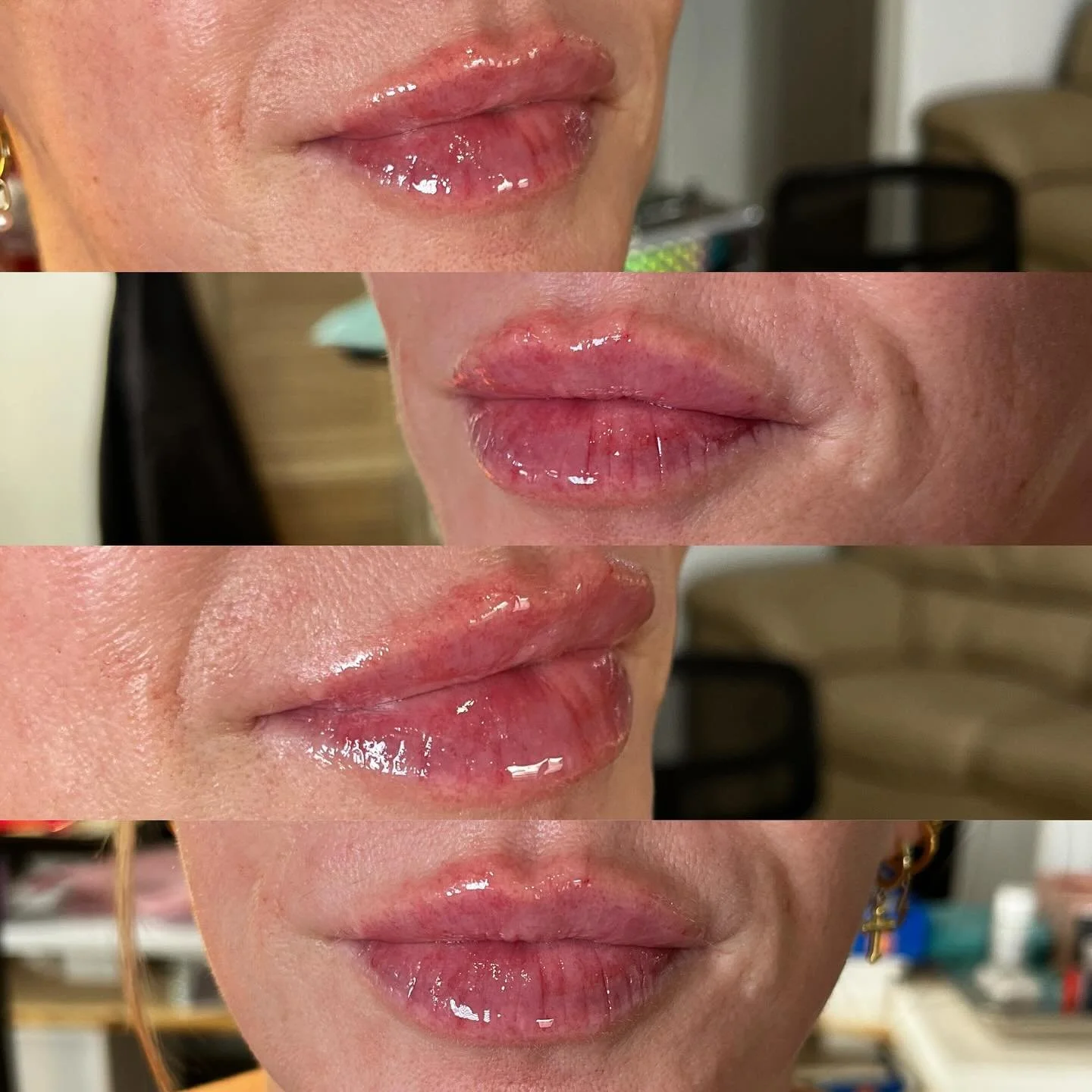 ✨ Half Syringe Refresh ✨

Not every appointment calls for a full syringe &mdash; sometimes a half syringe is exactly what you need.

Here&rsquo;s why:
💧 Hydration: Filler attracts and binds water, which helps soften and smooth fine lines.
🏛 Structu