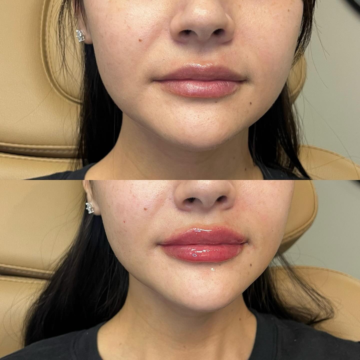 This beautiful girl came in requesting masseter tox &mdash; hoping to slim her jawline and create that snatched look everyone&rsquo;s been talking about.

But after assessing her, I realized her masseter muscles weren&rsquo;t actually overactive at a