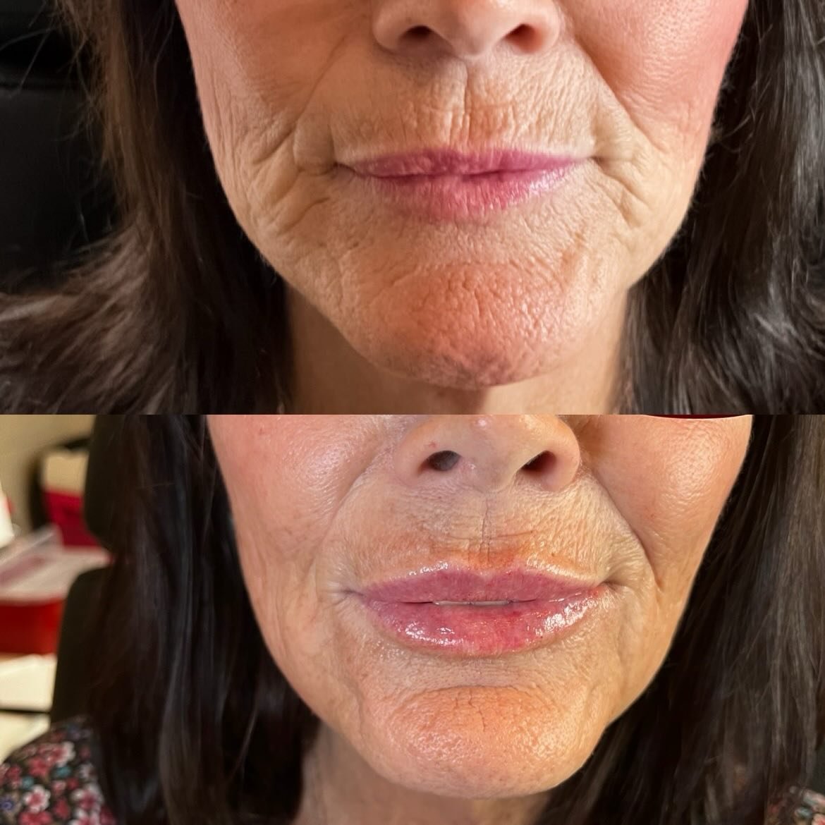 Patience is the secret ingredient in lower-face artistry. ✨

When we address pucker lines, frown lines, and that &ldquo;orange-peel&rdquo; chin texture with precise Botox placement, we&rsquo;re calming the overactive muscles that create those etched 