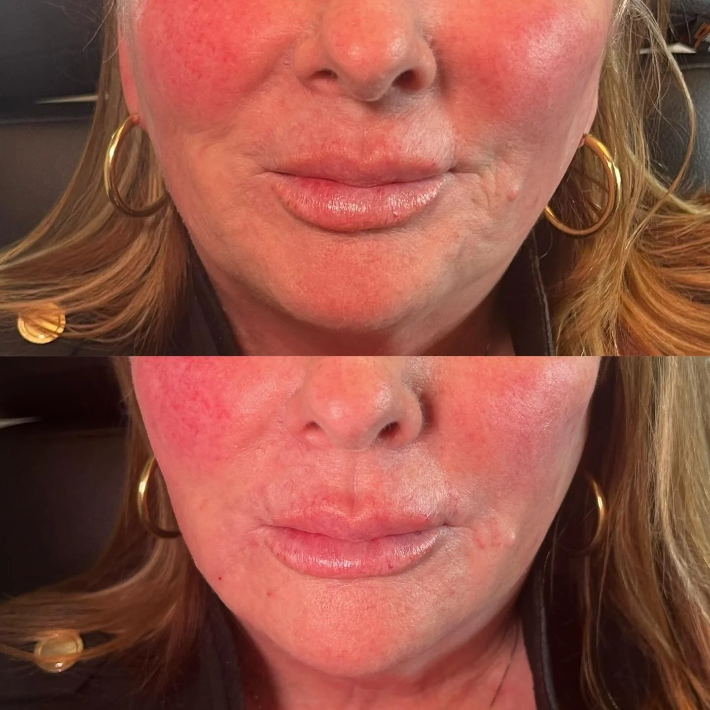 Lower face contouring is one of the most underrated ways to transform your profile.

Chin filler adds strength and length, balancing your proportions, sharpening the jawline, and slimming the lower face. It creates clean structure without looking &ld