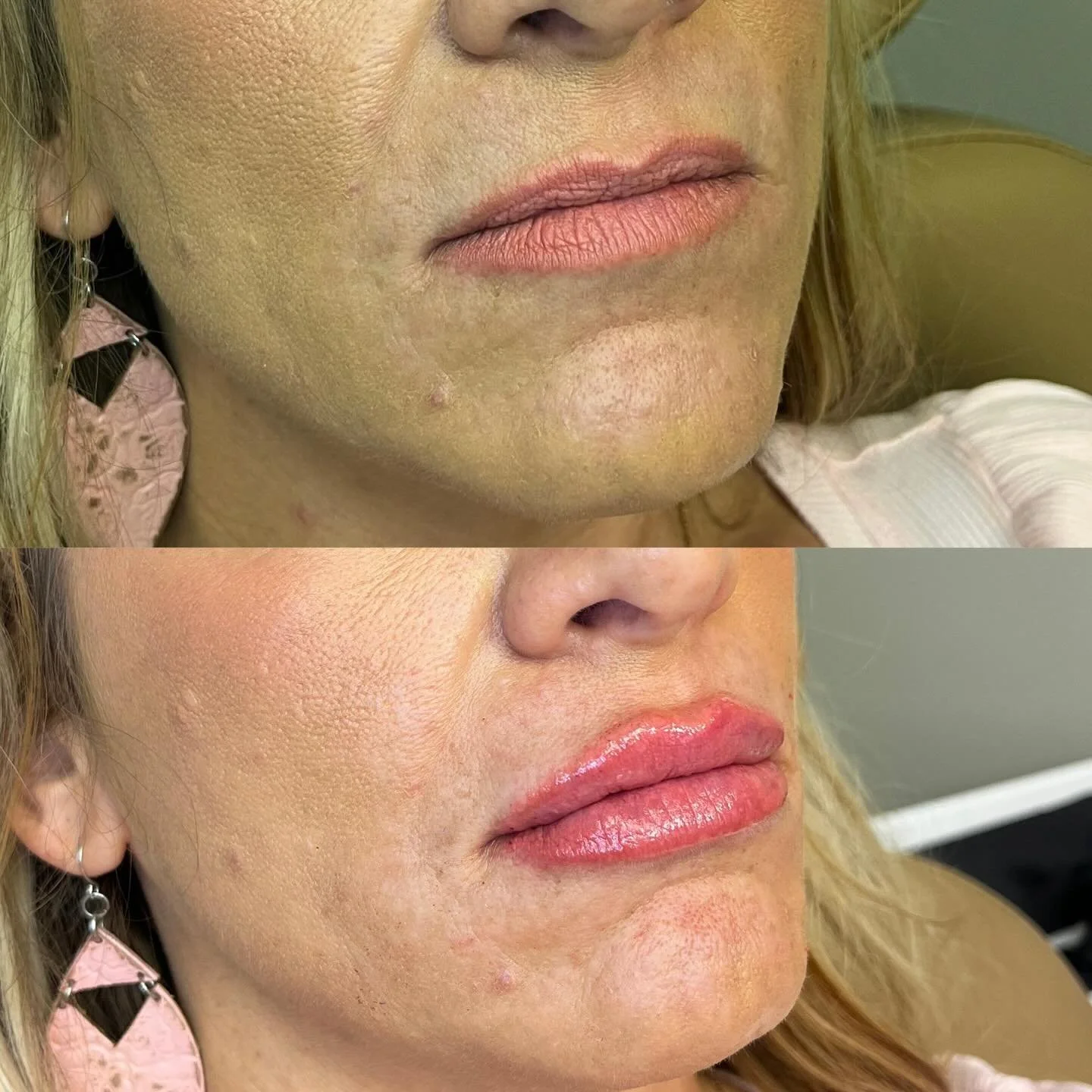 Did you know Juv&eacute;derm Ultra lip filler earns Allē points?
Allē is Allergan&rsquo;s rewards program that lets you save on future Botox and filler treatments just for doing what you already love.

✨ Why clients love Allē:
&bull; Earn points on J