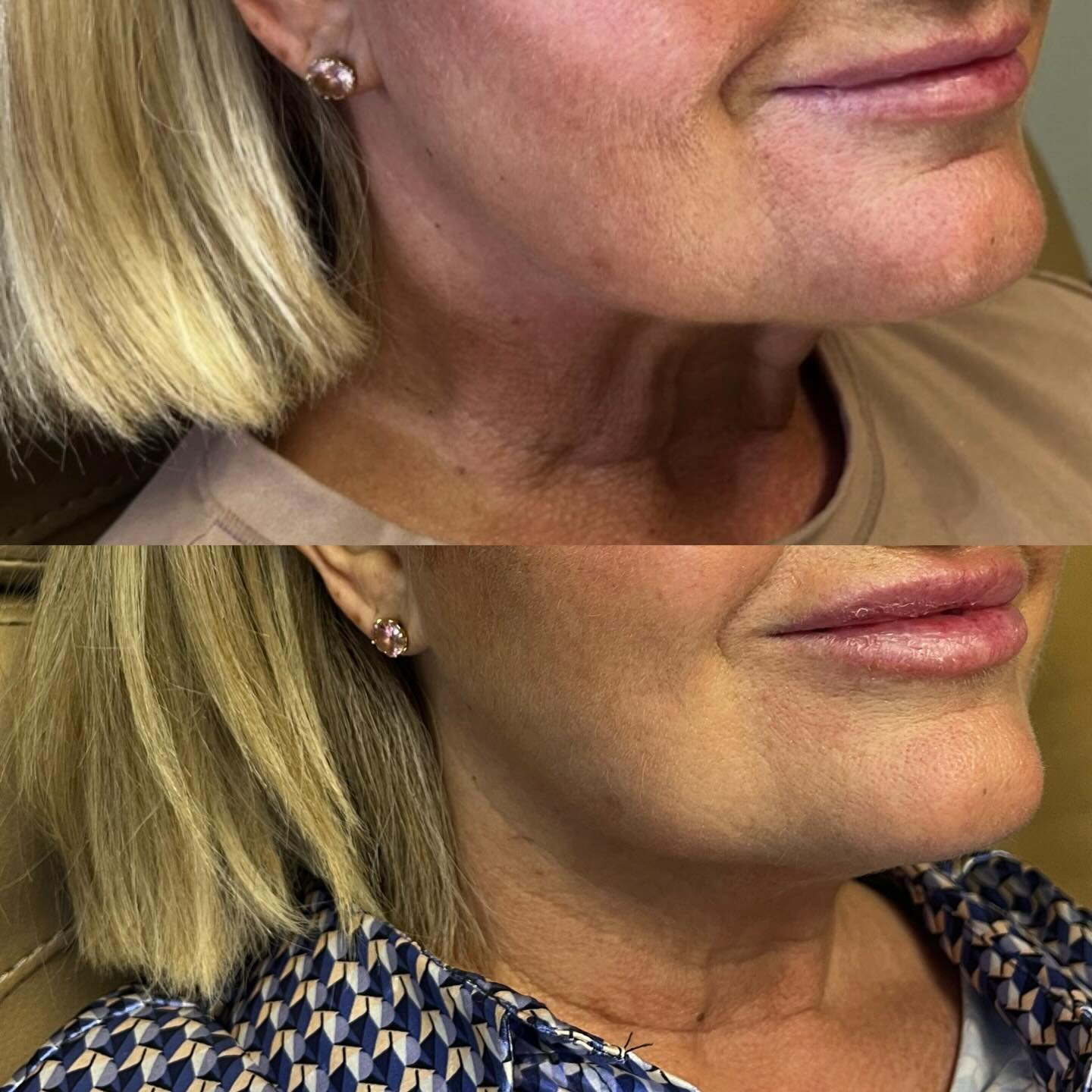 These results happened after just one round of neck band BOTOX. We added on some micro-tox at her follow up and she is VERY happy with the results. 😮&zwj;💨
It&rsquo;s 2026, no more neglect to the neck💓

Botox for the neck targets the platysma musc