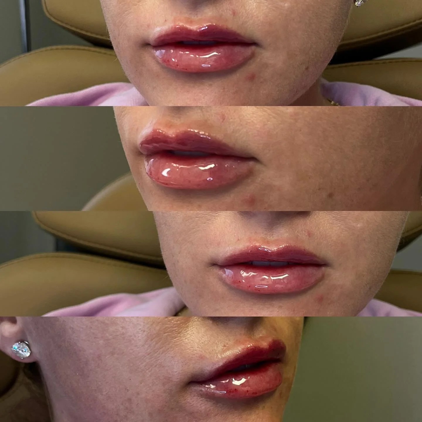Juvederm Ultra for that pillowy, perfect pout 🤍
New year, new lips, new goals, new outlook, NEW YOU🤍
$600 full syringe
$375 half syringe.

#lips #juicy #juvederm #facialbalance