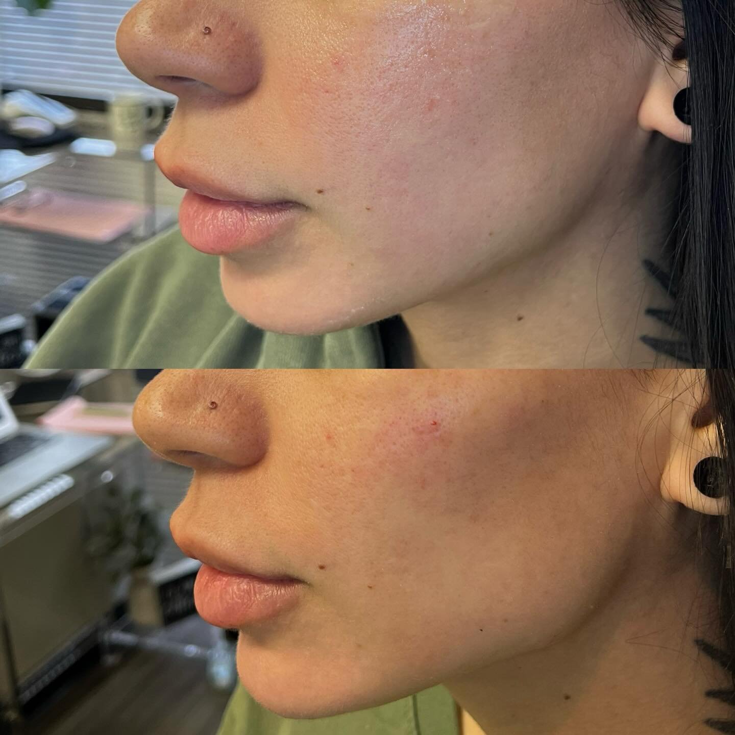 Facial balancing is the quiet luxury of aesthetics.

It&rsquo;s not about looking &ldquo;done.&rdquo;
It&rsquo;s about harmony.

✨ Cheeks &ndash; Restore volume where time has softened structure. Strategic placement lifts, supports the under-eye, and