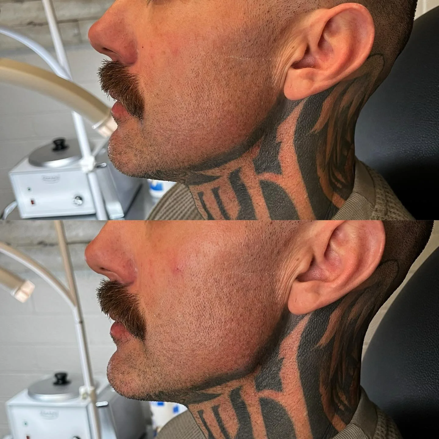 Radiesse for a strong jawline + chin.
Built for structure. Designed for definition.

Radiesse isn&rsquo;t about softness&mdash;it&rsquo;s about strength.
A sharper jaw. A projected chin. Masculine angles that hold their shape and improve over time as