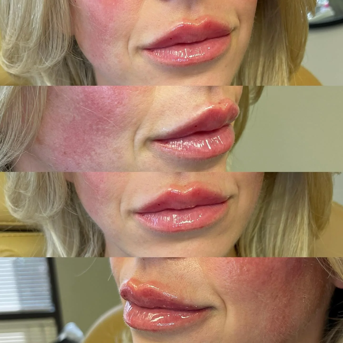 Lip filler, simplified 💉✨

A little volume.
A little structure.
A little balance.

Lip filler can:
&bull; Restore soft fullness 💋
&bull; Improve symmetry
&bull; Smooth fine lines
&bull; Define the border

Sometimes we pair it with a small lip flip 
