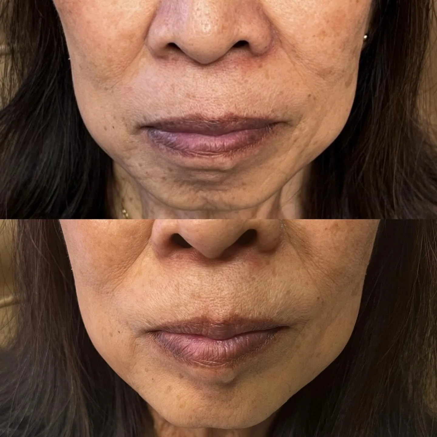 Lower face Botox so snatched, it looks like filler 😏✨

&bull; DAO &ndash; lifts mouth corners
&bull; Mentalis &ndash; smooths chin
&bull; Nefertiti lift &ndash; defines jawline + neck

Sculpted. Lifted. No added volume 💉

#botox #lowerfacebotox #ne