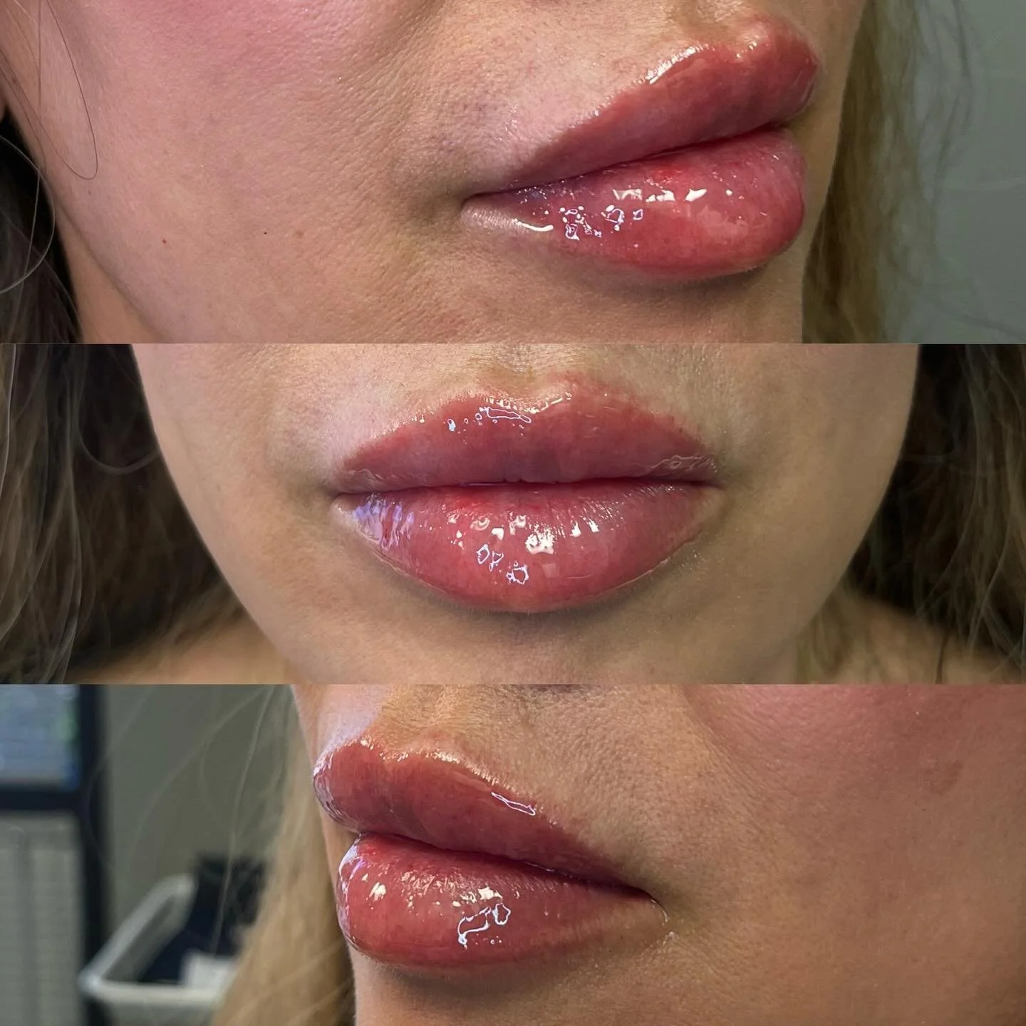 No caption needed 😮&zwj;💨💋
Full syringe $600🤍
Book online in Bio LINK 🔗