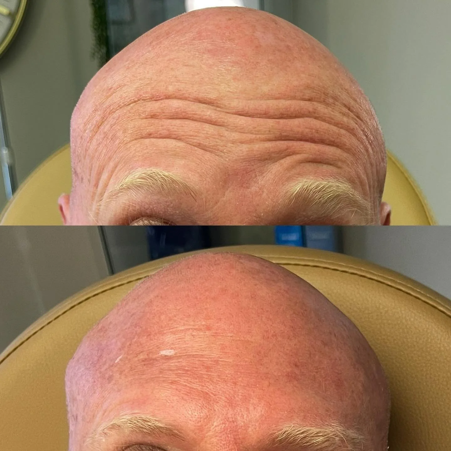 Brotox is officially in its era 💉

Men are done pretending they don&rsquo;t care about looking refreshed. This isn&rsquo;t about changing your face&mdash;it&rsquo;s about looking less tired, less stressed, and a little more in control.

We&rsquo;re 