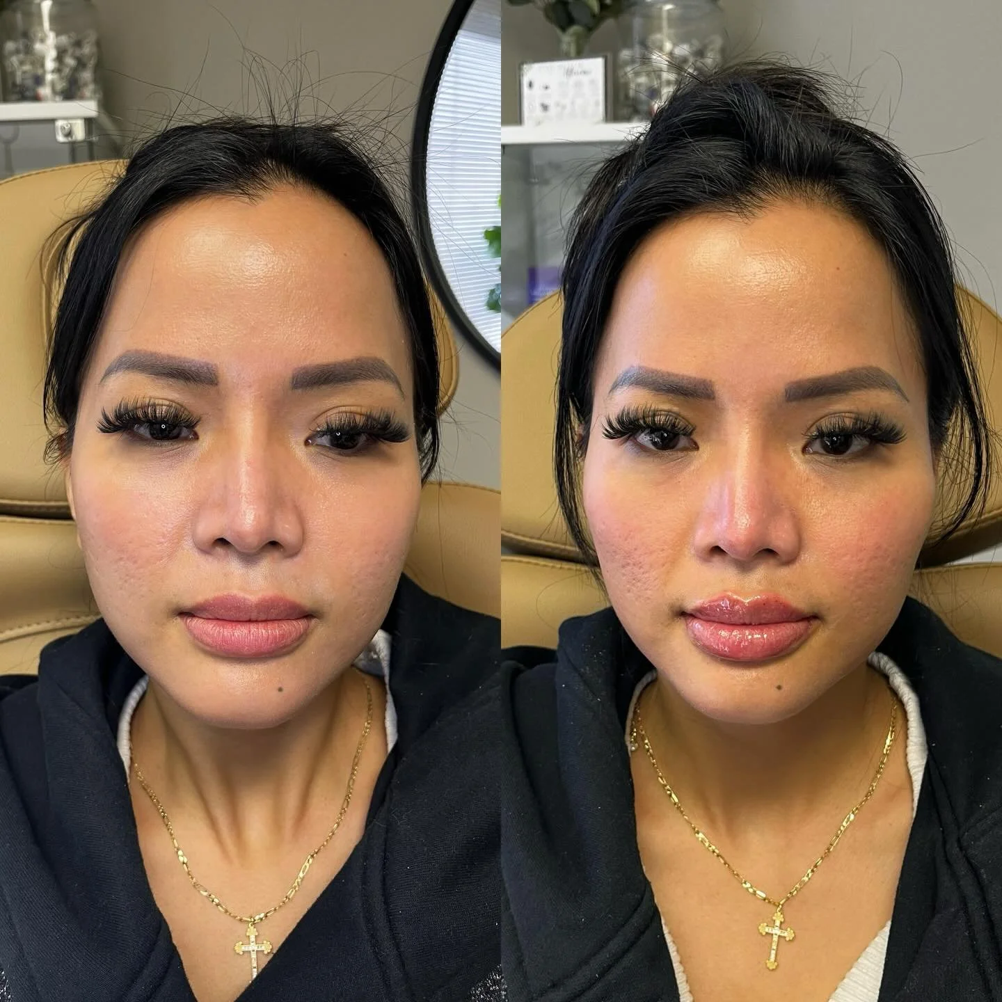 Cheek filler for a round face = instant elongation ✨

This result was achieved with just one syringe &mdash; proof that placement > volume.

By placing filler higher and slightly more lateral, we create:
&bull; the illusion of length instead of wi