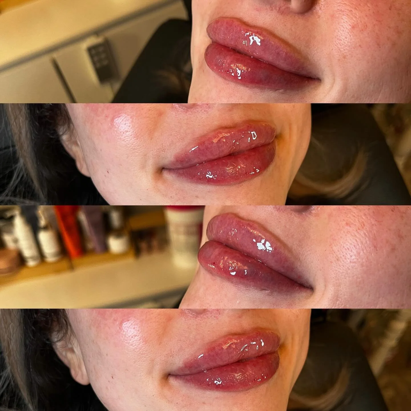 Full syringe energy 💋

This is your sign to stop playing small with your lips.
A full syringe gives you the structure, balance, and hydration you&rsquo;ve actually been wanting&mdash;not just a tease.

We&rsquo;re not overfilling&hellip; we&rsquo;re