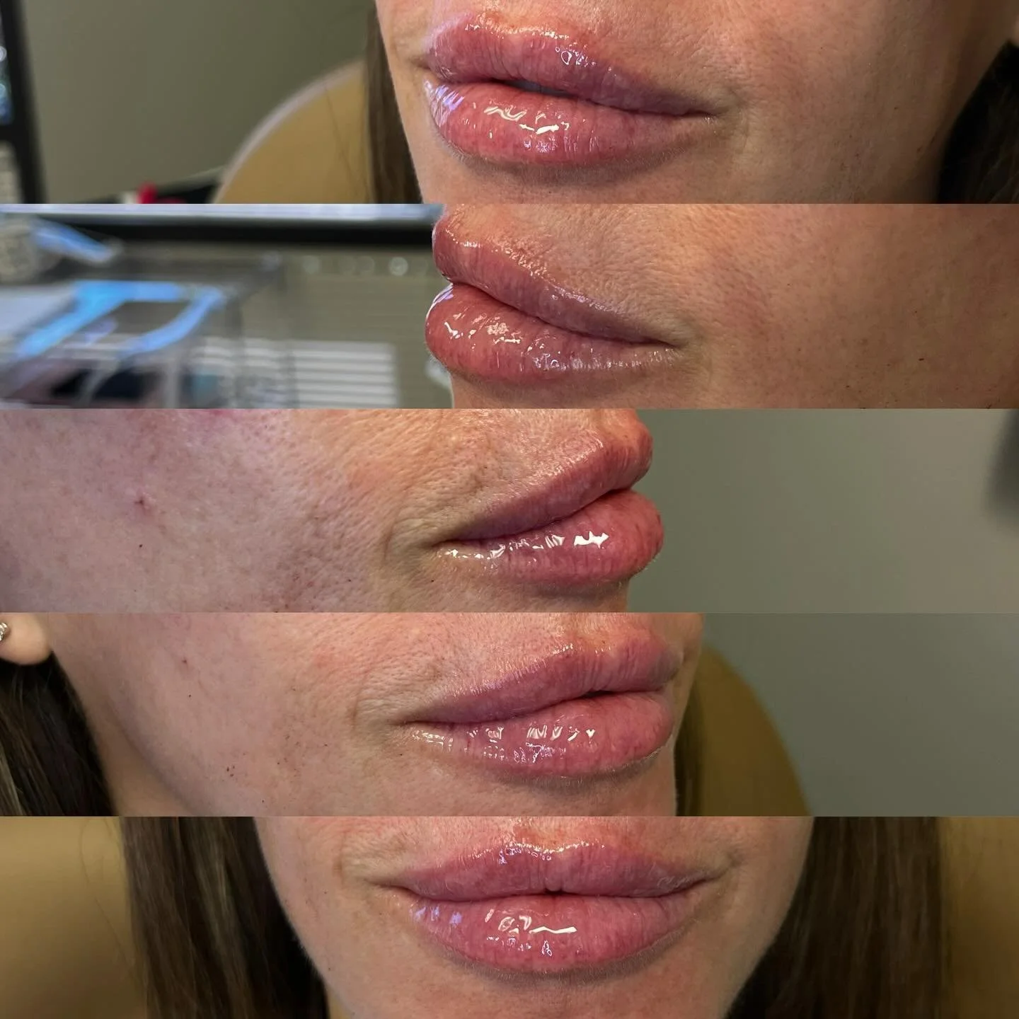 Fresh start energy 💉✨

Sometimes the best move isn&rsquo;t adding&hellip; it&rsquo;s refining. We started by dissolving previous filler that was too firm, softening the lips and restoring balance before rebuilding the right way.

Once the tissue res