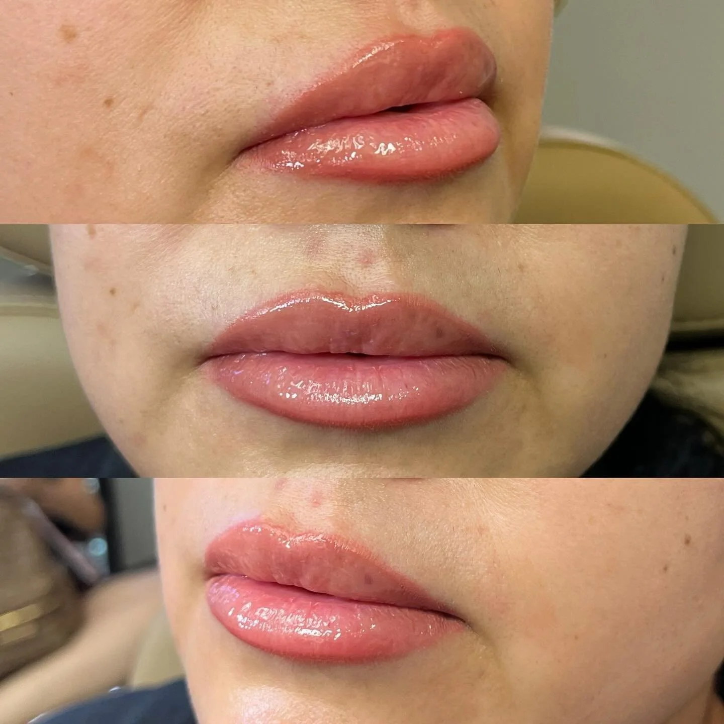 Lip filler settled 💋

Soft, balanced, and exactly how it should be once everything relaxes into place. Swelling is down, symmetry is showing, and that natural hydration is doing its thing.

This is why we trust the process&mdash;final results aren&r