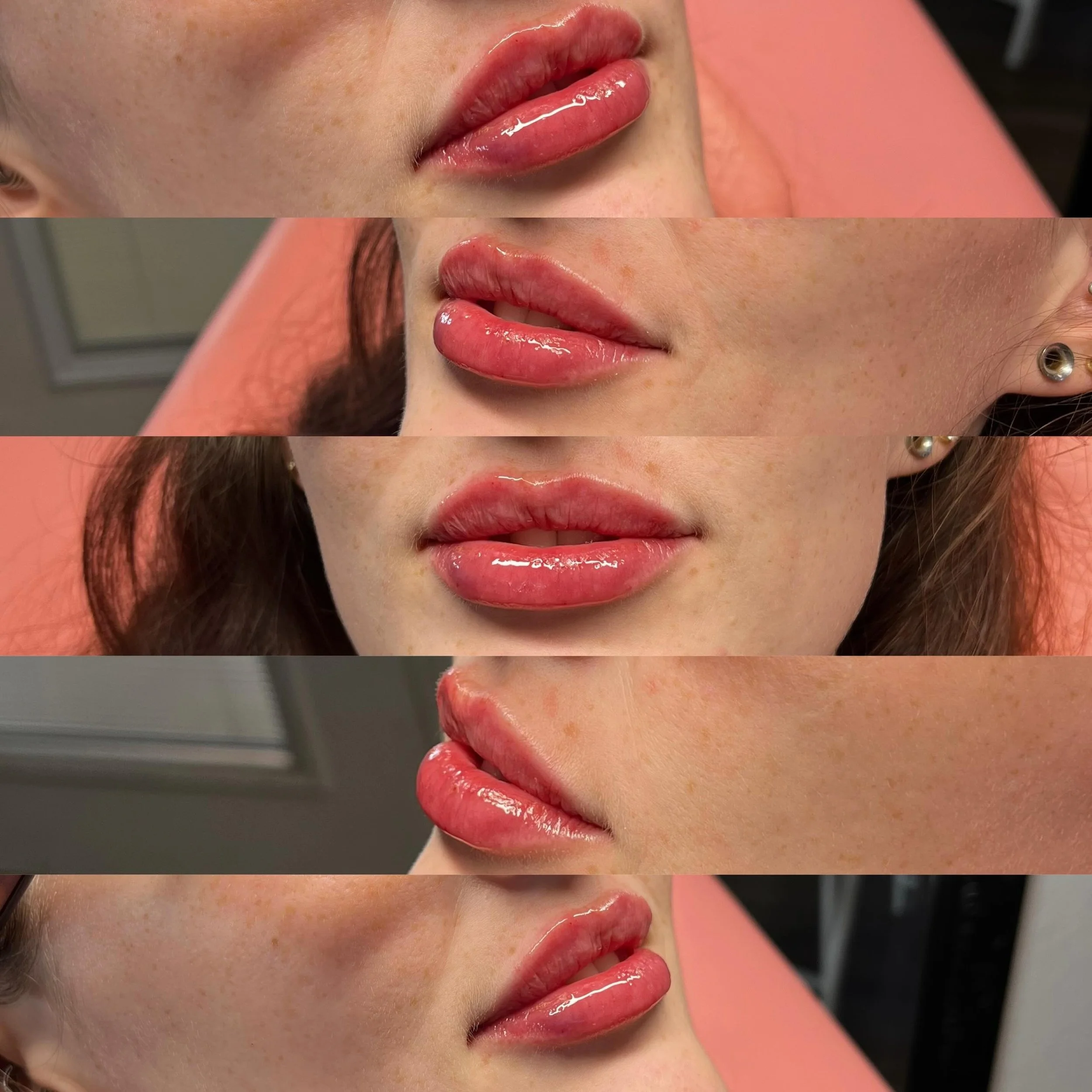 From childhood memories to treating the next generation 🥹🤍
Getting to do lip filler for the daughter of someone I grew up with was such a full circle moment.🫶

Lip filler is never just about volume to me &mdash; it&rsquo;s artistry, emotion, conne